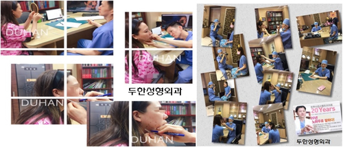 Double Eyelid Revision Surgery at Duhan Plastic Surgery Clinic - Asymmetric Double Eyelids, Pseudoptosis, and Lateral/Lower Canthoplasty image 47