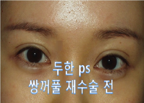 [두한성형외과]-쌍꺼풀 재수술 #눈재수술 #비대칭 눈교정 관련 이미지 1