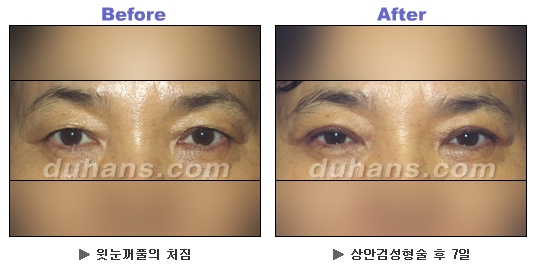 [두한성형외과 안검성형] - [상안검, 하안검] 관련 이미지 9