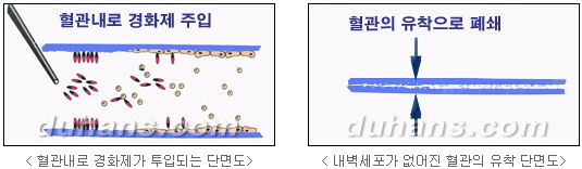 [두한성형외과 정맥류] - [하지정맥류, 정맥확장증, 혈관확장증] 관련 이미지 53