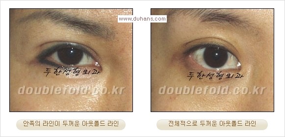 [두한성형외과 경쟁력 눈성형] - [두꺼운 아웃폴드 라인을 인폴드 라인으로 교정] 관련 이미지 1