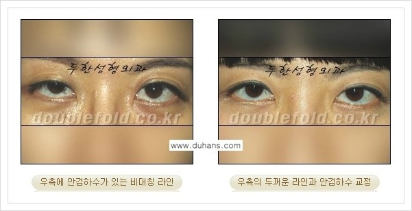 [두한성형외과 경쟁력 눈성형] - [짝짝이(비대칭) 쌍꺼풀 라인 교정하는 방법 안내 1.] 관련 이미지 10