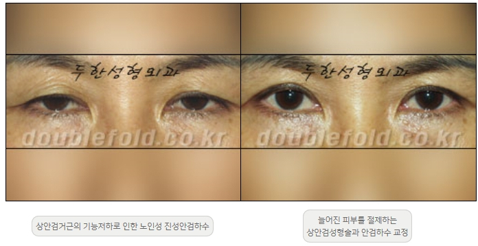 [Ptosis, Duhan Plastic Surgery] - [Sleepy-Looking Eyes, Ptosis Eye Correction] image 7