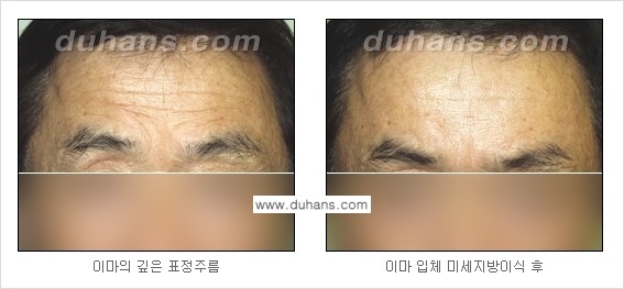 [두한성형외과 경쟁력 주름성형] - [지방이식을 이용한 이마주름, 미간주름 제거] 관련 이미지 12