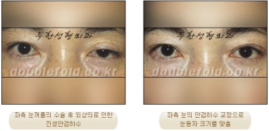 [Duhan Plastic Surgery Double Eyelid Surgery] - [Ptosis Correction Revision Surgery] image 9