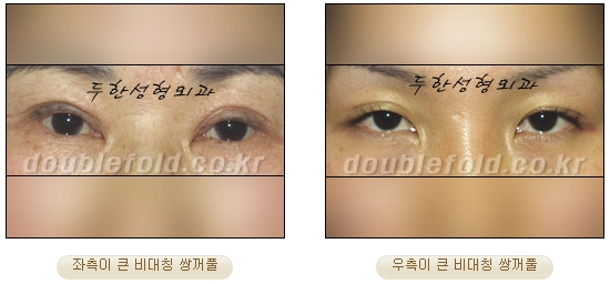 [Duhan Plastic Surgery Eye Surgery] - [Asymmetric Line, Eyelash Eversion, Deep Fixation] image 2