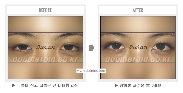 [두한성형외과 경쟁력 쌍꺼풀 재수술, 극한 눈재수술] - [망친 쌍꺼풀, 망가진 쌍꺼풀 복원수술, 재수술의 성공요건] 관련 이미지 12