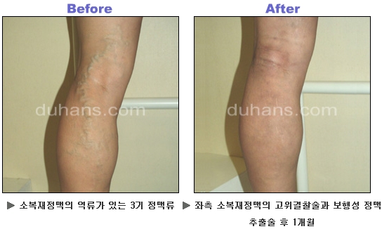 [두한성형외과 정맥류] - [하지정맥류, 정맥확장증, 혈관확장증] 관련 이미지 34