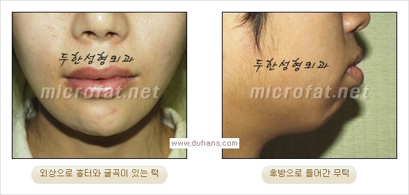 [두한성형외과 경쟁력 안면윤곽 교정] - [미세지방이식으로 무턱, 작은턱, 오목턱, 턱선의 비대칭 교정 안내] 관련 이미지 3