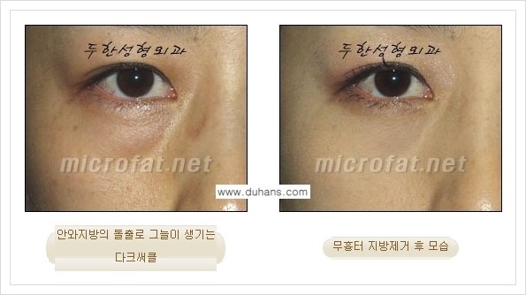 [두한성형외과 경쟁력 눈밑성형] - [눈밑지방제거, 눈위지방제거 안내 2.] 관련 이미지 17