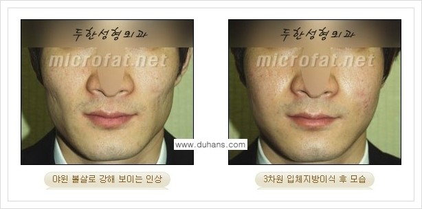 [두한성형외과 경쟁력 윤곽성형] - [볼, 볼살 지방이식] 관련 이미지 29