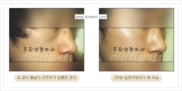 [두한성형외과 경쟁력 미세지방이식] - [귀족수술과 인디언밴드 교정 안내] 관련 이미지 8