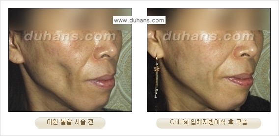 [두한성형외과 경쟁력 미세지방이식]-[Col-fat 입체지방이식 사례 안내] 관련 이미지 11
