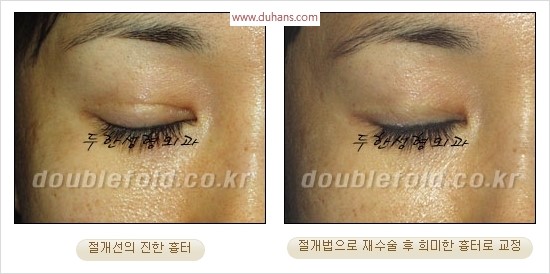 [두한성형외과 경쟁력 쌍꺼풀 재수술 리더] - [쌍꺼풀 흉터선, 쌍꺼풀 흉터 유착 교정술 안내] 관련 이미지 11