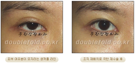 쌍꺼풀수술 두한성형외과 - 쌍커풀재수술의 문제점 관련 이미지 7