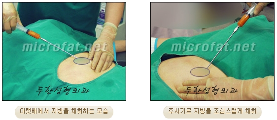 [두한성형외과 얼굴지방이식] - [측두부, 관자놀이] 관련 이미지 3