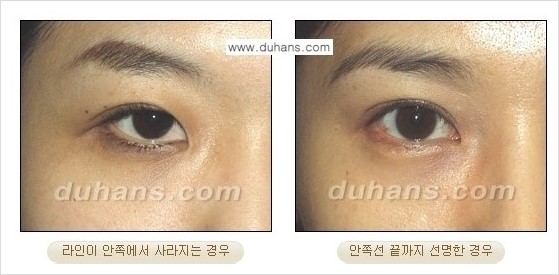 ​[두한성형외과 경쟁력 쌍꺼풀 재수술] - [아름다운 쌍꺼풀 선의 기준과 쌍꺼풀 재수술시 검사와 테스트 안내] 관련 이미지 6