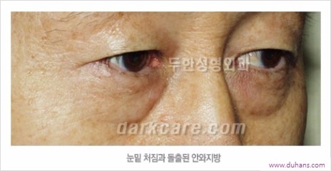 [두한성형외과 경쟁력 눈밑성형] - [하안검성형(눈밑주름제거술)과 눈밑지방재배치안내] 관련 이미지 2