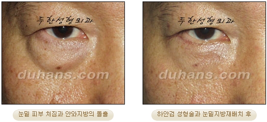 [Duhan Plastic Surgery Ophthalmic Plastic Surgery] - [Lower Blepharoplasty] image 14