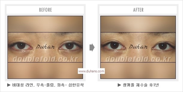 [두한성형외과 경쟁력 눈성형] - [나에게 맞는 어울리는 쌍꺼풀 라인] 관련 이미지 36