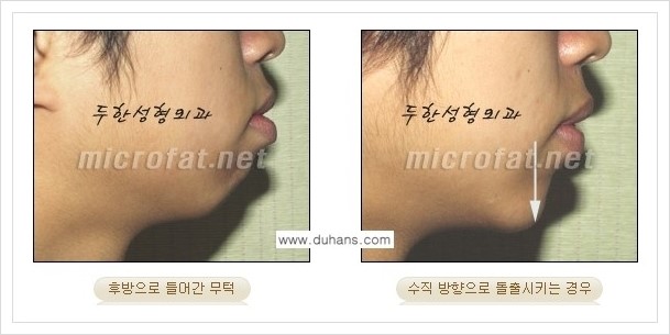 [두한성형외과 경쟁력 미세지방이식] - [얼굴 윤곽 무턱교정 안내 ①] 관련 이미지 7