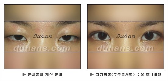 [두한성형외과 쌍커풀수술] - [눈성형 방법에 대한 자주하는 질문과 답변] 관련 이미지 117