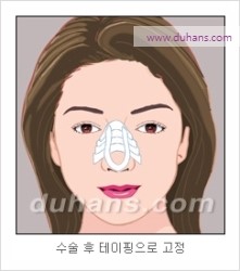 [두한성형외과 경쟁력 코성형 리더] - [자연스럽고 오똑한 콧망울! 코성형 방법]​ 관련 이미지 11