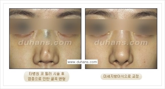 [두한성형외과 경쟁력 주름성형] - [필러주사(쥬비덤)에 대한 올바른 정보 안내] 관련 이미지 3