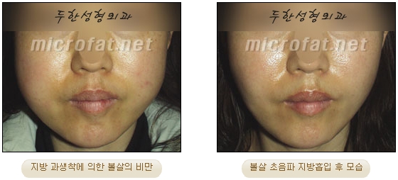 [Duhan Plastic Surgery Liposuction] - [Facial Liposuction] image 17