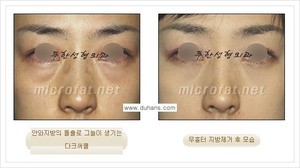 [두한성형외과 경쟁력 눈밑성형] - [눈밑지방제거, 눈위지방제거 안내 2.] 관련 이미지 7