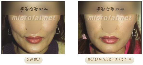 [두한성형외과 미세지방이식] - [자가지방이식] 관련 이미지 14