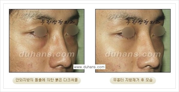 [두한성형외과 경쟁력 안검성형] - [눈밑 지방제거 안내] 관련 이미지 24