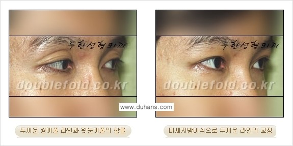[두한성형외과 경쟁력 눈성형] - [미세지방이식으로 두꺼운 쌍꺼풀 라인의 교정 방법 안내] 관련 이미지 13