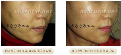 [두한성형외과 얼굴지방이식] - [볼지방이식] 관련 이미지 37