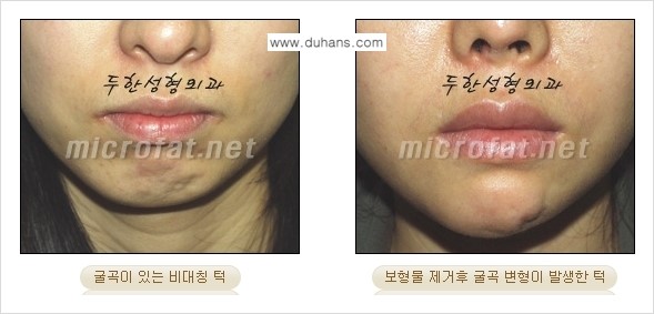 [두한성형외과의 경쟁력 미세지방이식] - [무턱교정 - 턱 미세지방이식 안내 1.] 관련 이미지 3