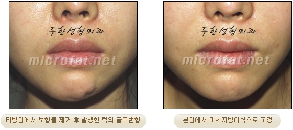 [두한성형외과 미세지방이식] - [무턱교정 안내] 관련 이미지 8