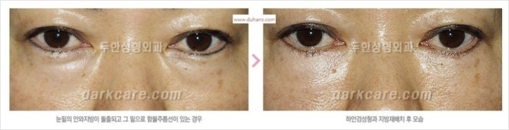 [두한성형외과 경쟁력 눈밑성형] - [다크써클의 모든 것] 관련 이미지 28