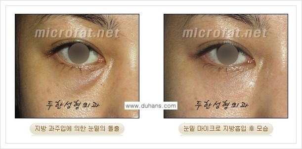 [두한성형외과 겨울엔 지방흡입을] - [볼살, 눈밑, 턱선의 초음파 미세지방흡입 1.] 관련 이미지 10