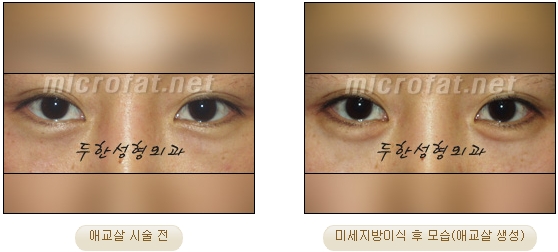​[두한성형외과 지방이식] - [애교살] 관련 이미지 7