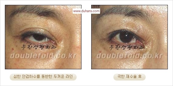 [두한성형외과 경쟁력 쌍꺼풀 재수술] - [두꺼운 라인을 교정하는 극한 재수술(Extreme Rroperation)] 관련 이미지 5