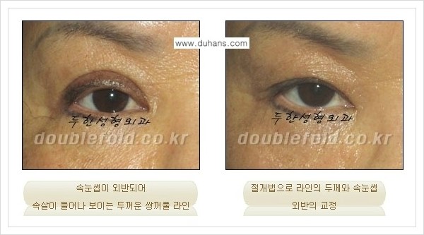 [두한성형외과 경쟁력 쌍꺼풀 재수술, 극한 재수술] - [망가진 눈 복원수술 - 속눈썹 외반 교정 안내] 관련 이미지 7