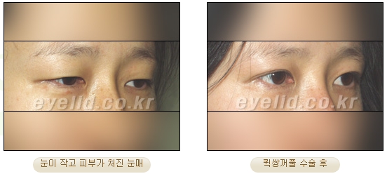 [Duhan Plastic Surgery Eye Surgery] - [First Double Eyelid Surgery] image 20