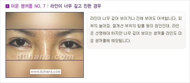 [두한성형외과 경쟁력 쌍꺼풀 재수술, 극한 눈재수술] - [자연스러운 눈매로의 복원 쌍꺼풀 재수술 대상 안내] 관련 이미지 8