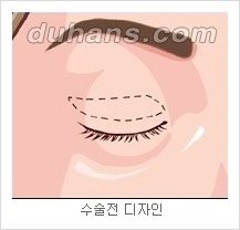 [두한성형외과 경쟁력 눈성형] - [젊은 눈매로의 복원 안검성형] 관련 이미지 1