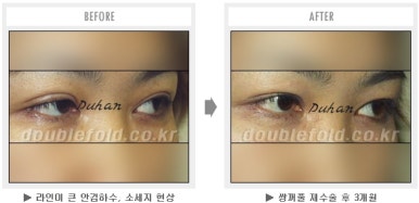 두한성형외과 쌍커풀 재수술 - 짝눈 눈매교정, 가성 안검하수 교정과 뒤밑트임 관련 이미지 48