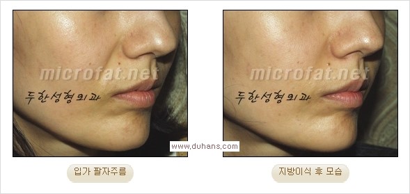 [두한성형외과 경쟁력 주름성형] - [입가와 팔자의 주름제거 지방이식 2.] 관련 이미지 2