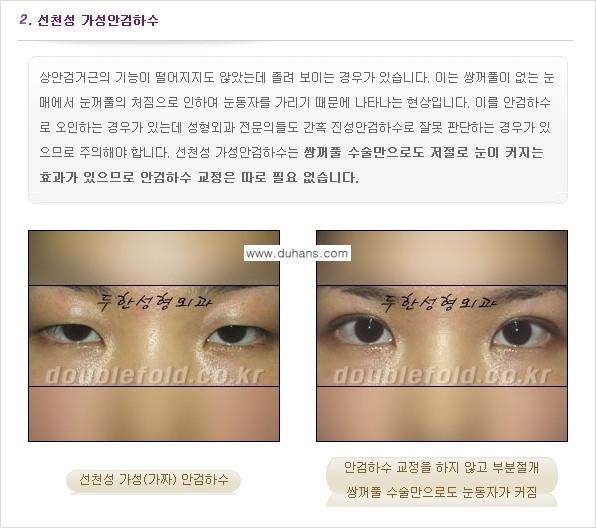 [두한성형외과 경쟁력 눈성형] - [안검하수(졸린 눈매) 재수술 안내 ①] 관련 이미지 4