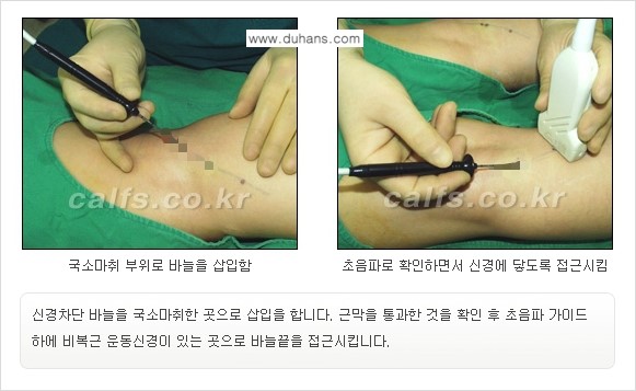[두한성형외과 경쟁력 멀티종아리성형] - [종아리성형 방법별 전후 주의사항] 관련 이미지 8
