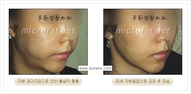 [두한성형외과 경쟁력 볼살지방이식] - [타병원 지방이식 후 - 굴곡이 발생한 경우, 과주입으로 인해 볼살이 불룩한 경우 안내] 관련 이미지 11