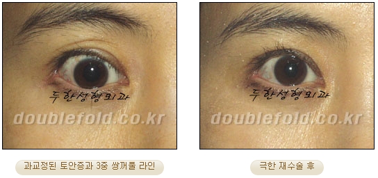 [DoubleFold Plastic Surgery Eye Surgery] - [Revision Surgery for Thick Double Eyelids] image 43